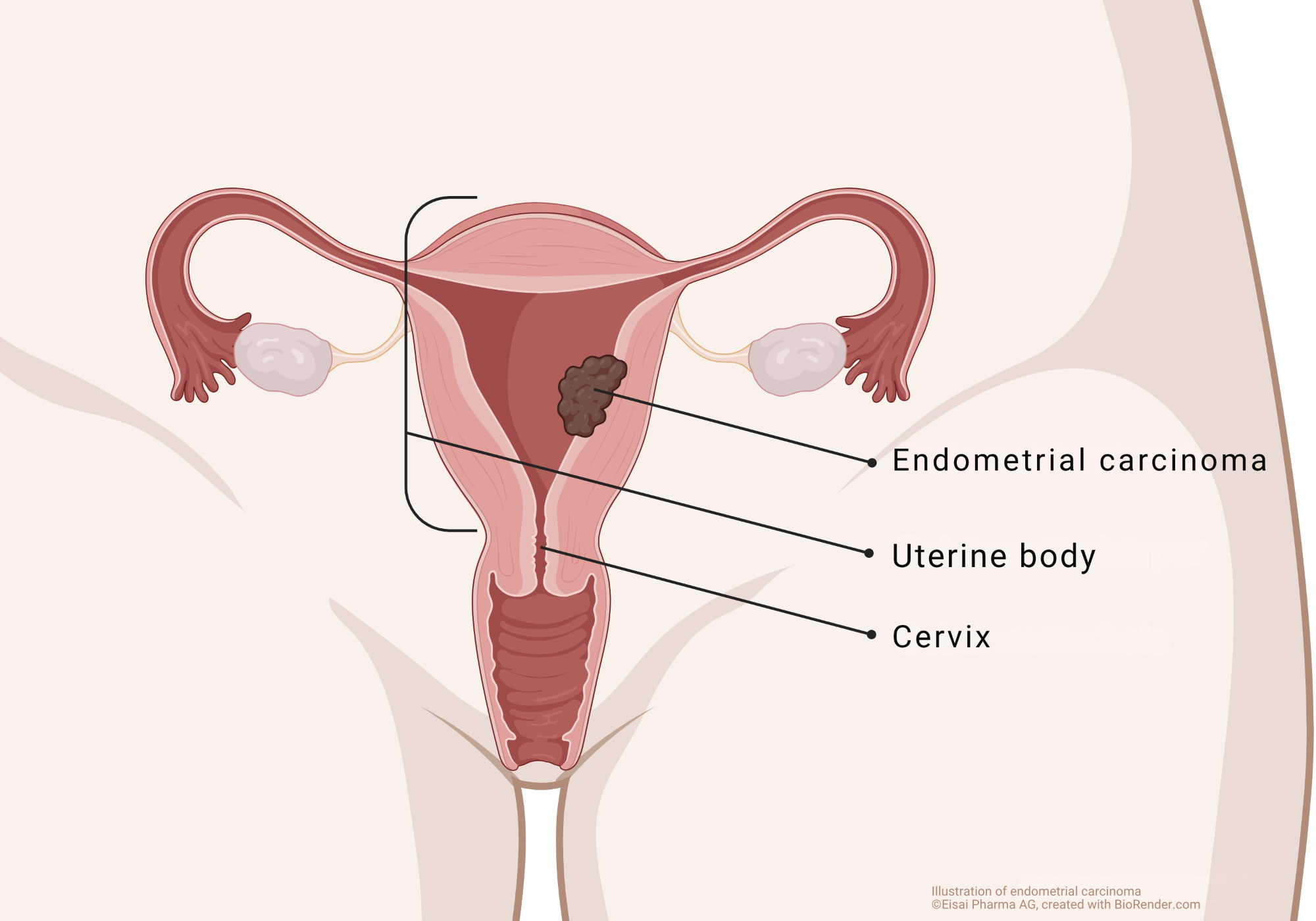 _Onkologie-Endometriumkarzinom_2 Oncology