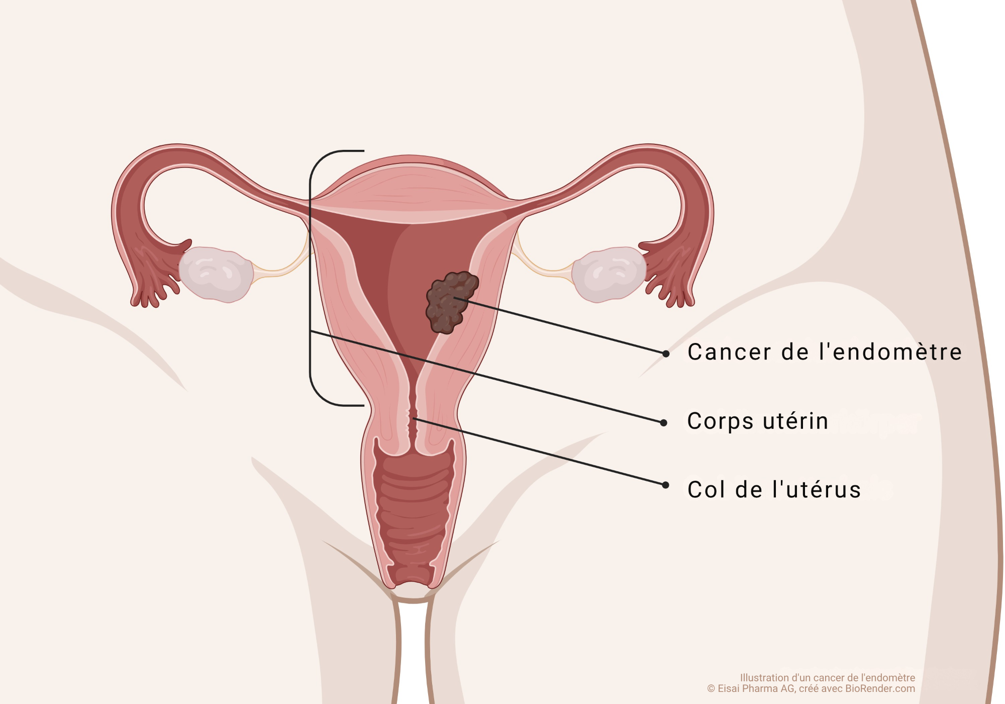 _Onkologie-Endometriumkarzinom_2 Onkologie