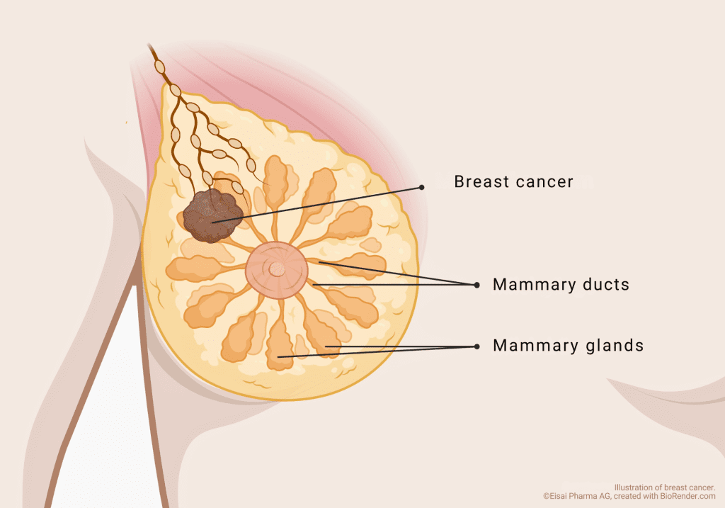 _Onkologie-Brustkrebs_2 Breast cancer, also known as mammary carcinoma in medicine, is a tumor disease of the breast.